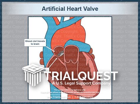 Artificial Heart Valve - Trial Exhibits Inc.