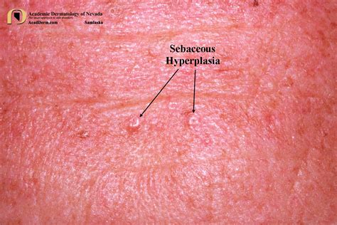 Sebaceous Hyperplasia: Tiny Yellow Donuts... - Academic Dermatology of Nevada