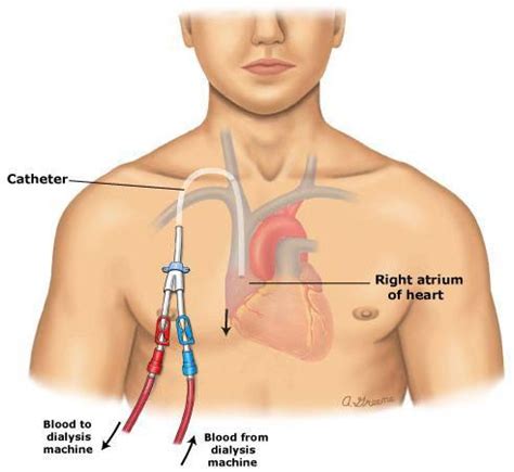 Central Venous Catheter Market Size, Trends, Shares, Insights, Forecast - Coherent Market ...