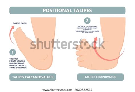 20 Calcaneovalgus 이미지, 스톡 사진 및 벡터 | Shutterstock