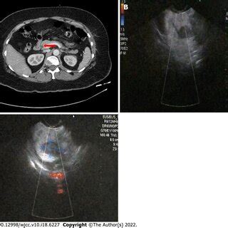 Imaging examinations. A: Computed tomography image for neuroendocrine... | Download Scientific ...