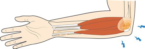 What is Ulnar Nerve Entrapment (Cubital Tunnel Syndrome)? - Upswing Health