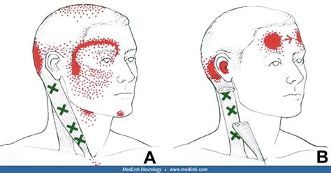 Myofascial pain syndrome | MedLink Neurology