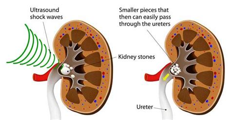 Lithotripsy (ESWL) - Shock Wave Lithotripsy for Kidney Stone Treatment