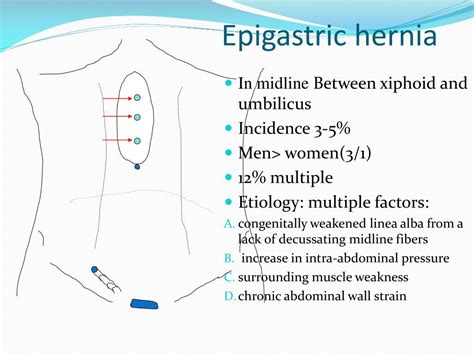 PPT - hernia PowerPoint Presentation, free download - ID:2957512