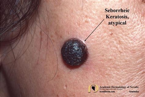 Seborrheic Keratosis: Atypical Forms... - Academic Dermatology of Nevada