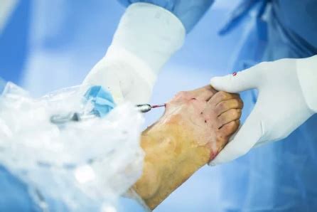 ANKLE ARTHROSCOPY - Midwest Orthopaedics