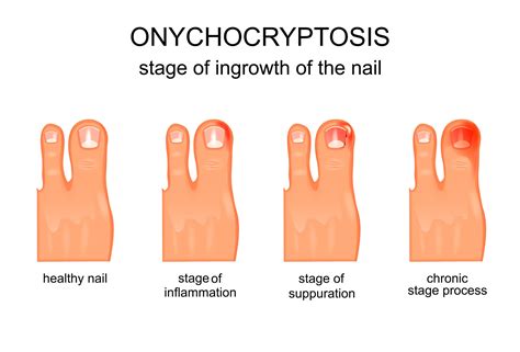 Ingrown Toenail | Will It Go Away l Medical Nail Trim | Podiatry Tips