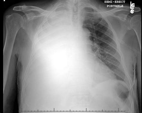 Chest X Ray Consolidation