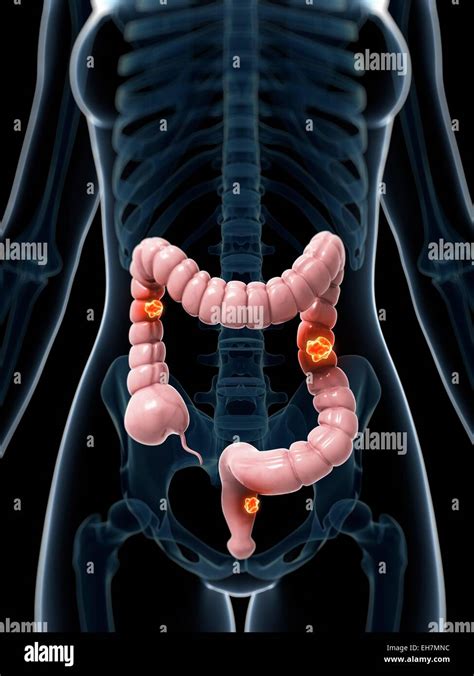 Human colon cancer, illustration Stock Photo - Alamy