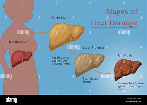 Stages of liver damage due to alcoholism. First alcohol compromises the liver, causing large ...