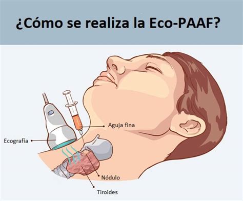 Eco-Paaf para diagnosticar nódulos tiroideos | Tu canal de salud