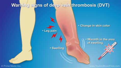 Understanding and Diagnosing VTE