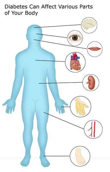 Complications - Diabetes Education Online