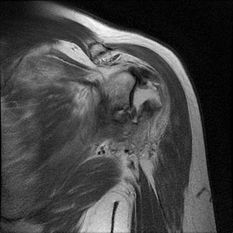 Bankart Lesion Mri