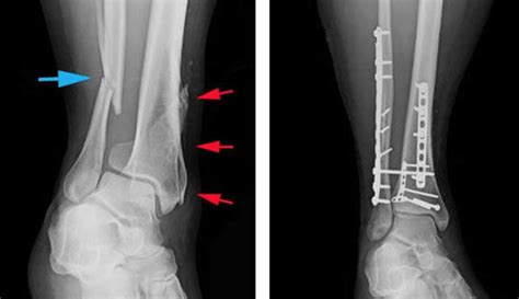 Tibial shaft fracture causes, types, symptoms, diagnosis, treatment ...