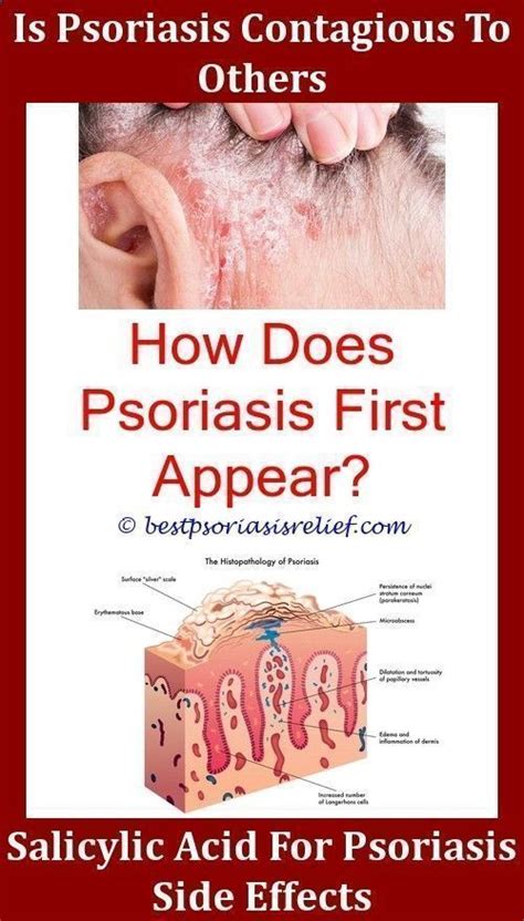 Psoriasis Diet Scalp Psoriasis How To Treataloe vera for psoriasis ...