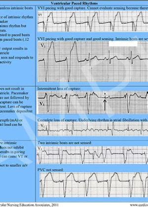 12 Lead ECG Reference Chart (PDF) – Cardiovascular Nursing Education ...