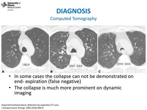 Dynamic Central Airway Obstruction: Tracheomalacia, Tracheobronchomalacia, And Excessive Dynamic ...