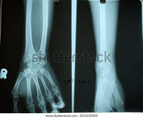 X Ray Wrist Dislocation Radius Bone Stock Photo 2251210353 | Shutterstock