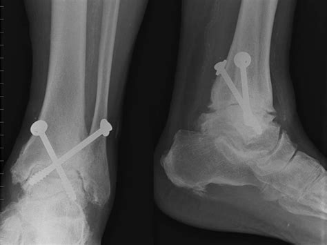 Arthroscopic Ankle and Subtalar Arthrodesis – Indications and Surgical Technique | IntechOpen