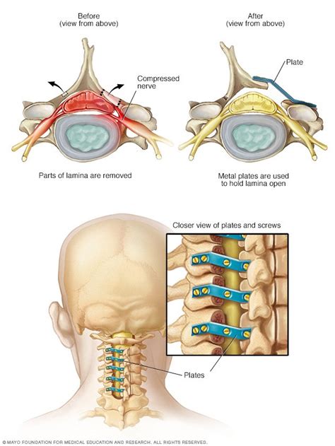 Spinal stenosis Disease Reference Guide - Drugs.com