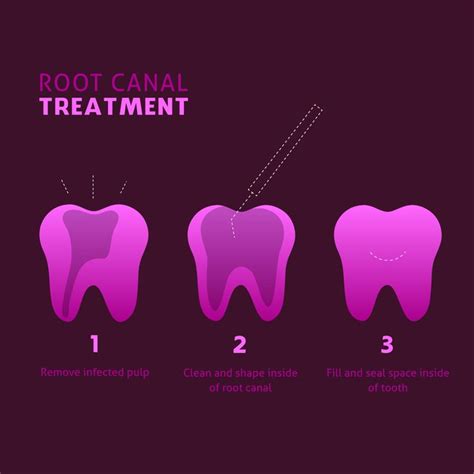the stages of root canal treatment