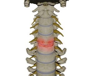 Cervical Degenerative Disc Disease | Advanced Orthopaedics & Sports ...