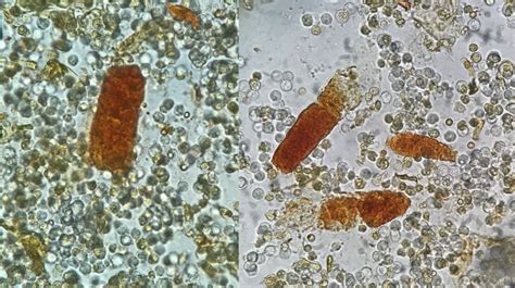 Urine Sediment of the Month: Pigmented Casts & What Those Pretty Colors Tell Us - Renal Fellow ...