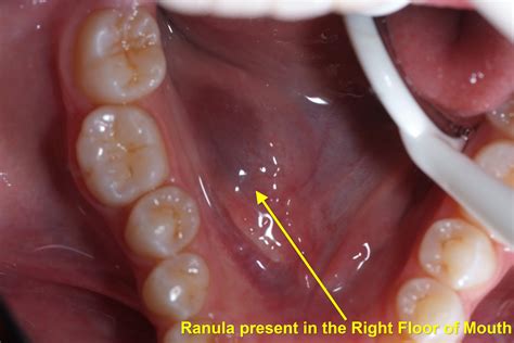 Ranulas / Ranulæ & Their Treatment – Exodontia