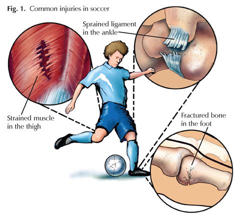 Soccer Players: Sprains, Strains, and Breaks - Hughston Clinic