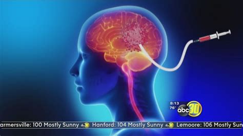 Brain Tumor Cath: Glioblastoma GPS - ABC30 Fresno