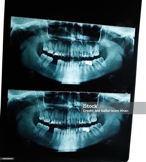 Dental Xray Orthopantomography Or Opg Stock Photo - Download Image Now ...