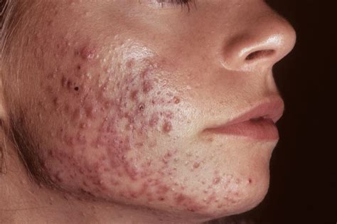 Improving Subjective Grading of Acne Using Convolutional Neural Networks - Dermatology Advisor