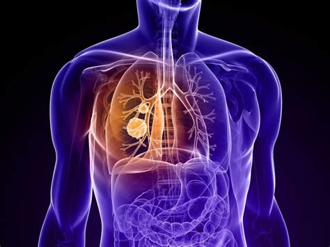 Non-small cell lung cancer: causes, diagnosis, stages of the disease ...