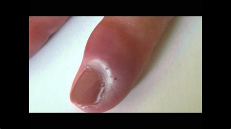 Nail Bed infection - YouTube