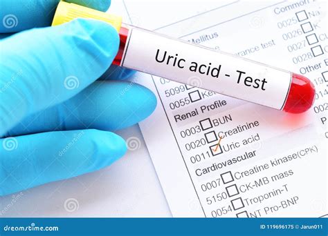 Blood For Uric Acid Test Stock Photography | CartoonDealer.com #106681808