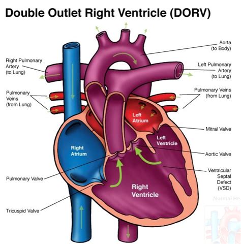 Post-delivery graphic anatomy: DORV - OB Images