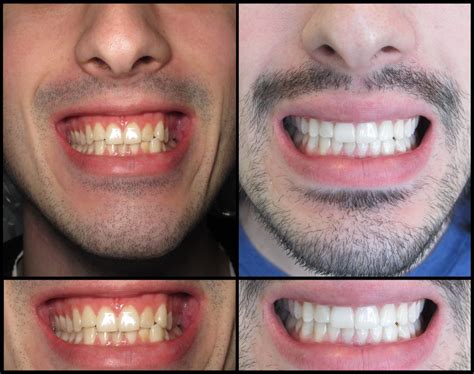 6 Veneers Teeth, Dental Veneers, Veneers Cost, Porcelain Veneers ...