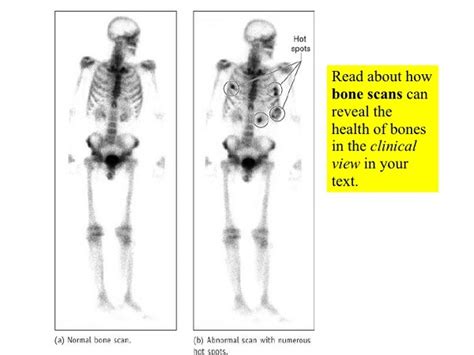 Can A Bone Scan Show Cancer - CancerWalls