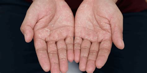 Dyshidrotic Eczema (Dyshidrosis): Overview,Symptoms, causes, and treatment