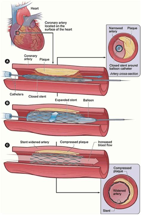 Restenosis, in-stent restenosis causes, symptoms, diagnosis, treatment & prognosis