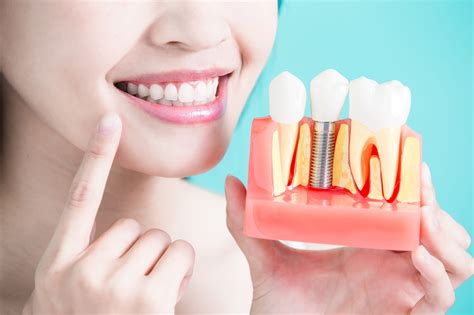 What You Need to Know About Dental Implants: Cleaning and Maintenance - University Dental San Diego