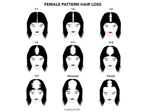 Guide to Female Pattern Baldness (Androgenic Alopecia): Causes, Symptoms and Treatments in ...