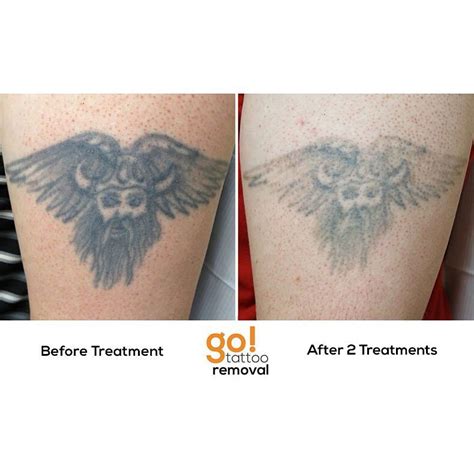 GO! Tattoo Removal • Significant fading on this 20+ year old tattoo...