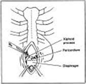 Pericardial Window Techniques; Pericardiostomy