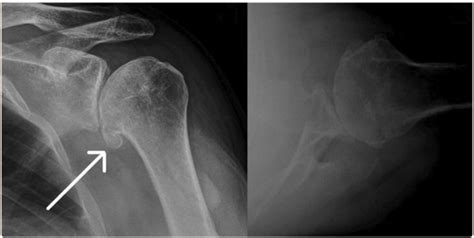 Treating Glenohumeral Osteoarthritis- Sports Medicine Review