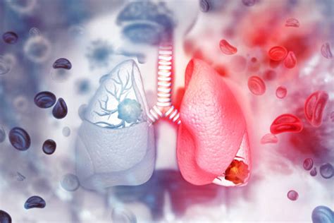 Metastatic Renal Cell Carcinoma | Dr. Sandeep Nayak