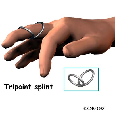 Physical Therapy in Baker County for Swan Neck Deformity of the Finger