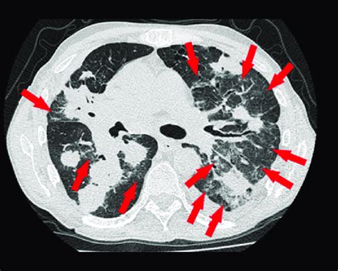 Chest high-resolution computed tomography: tumor in the hilum of the ...